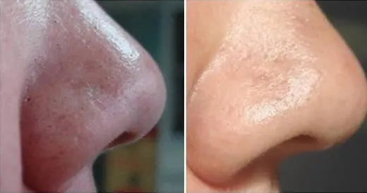 e' possibile rimuovere i punti neri con il bicarbonato