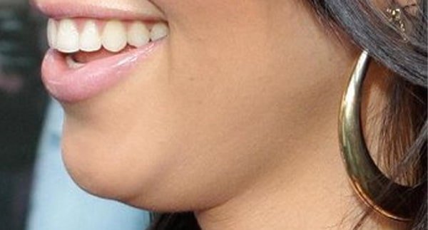 il doppio mento anche nelle persone magre