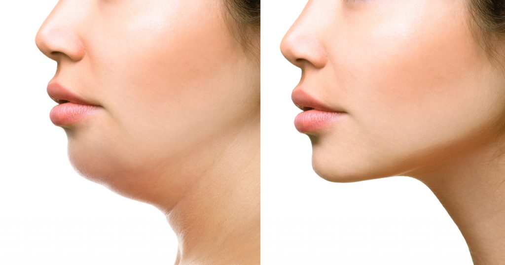 cause del doppio mento: perché si forma