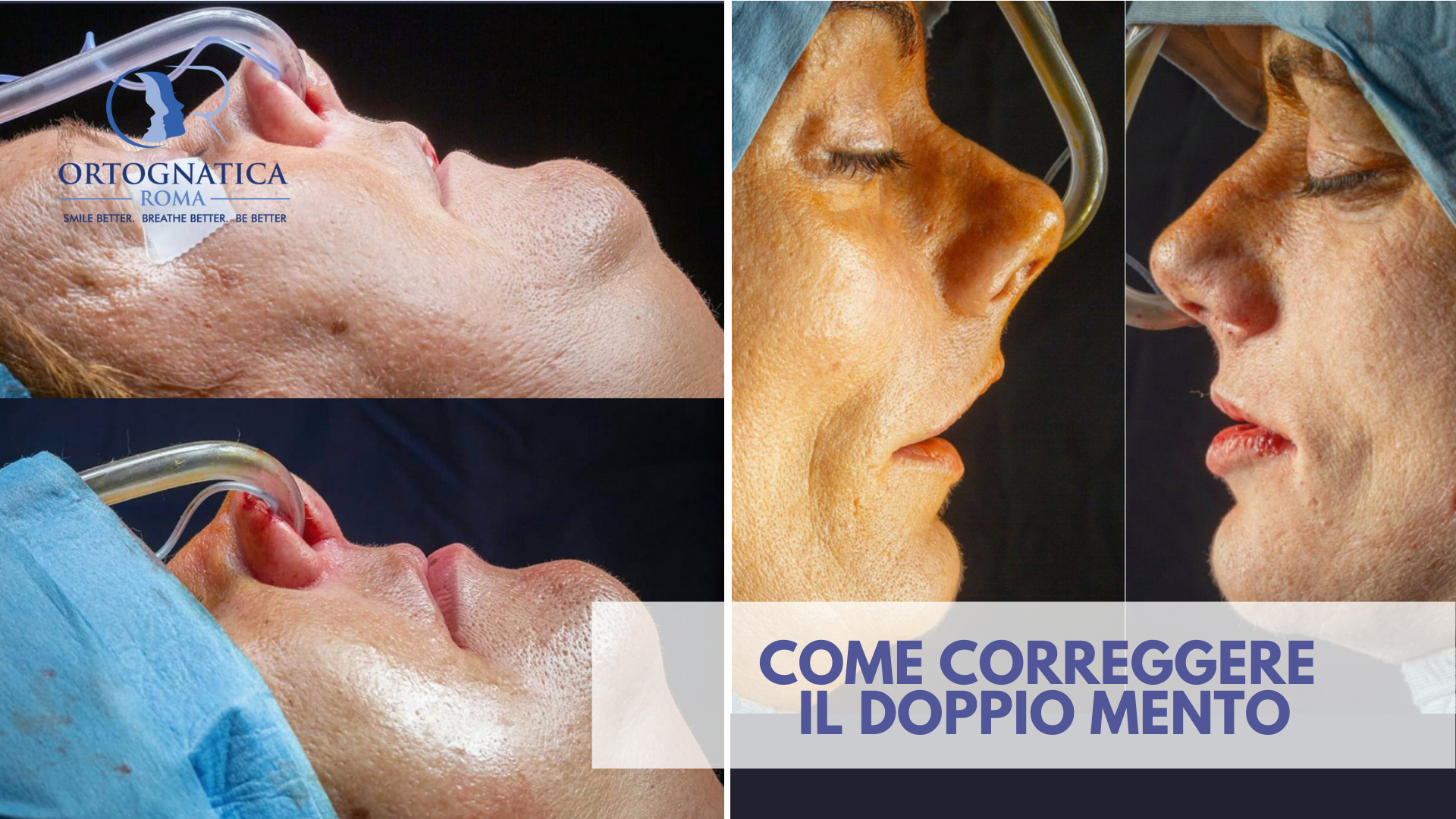 cos\è il doppio mento