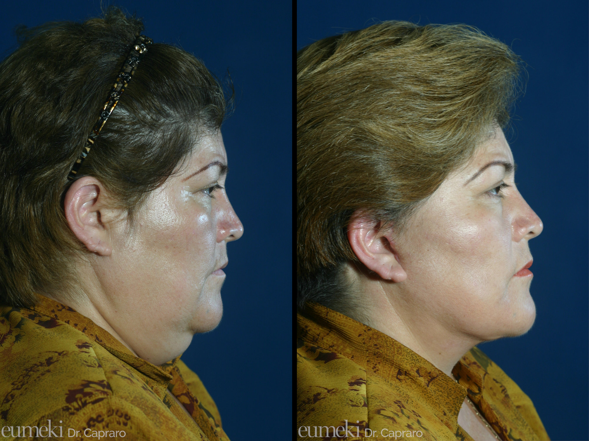 4. liposuzione e lifting del collo