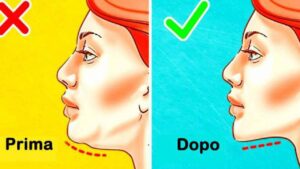 Prima e dopo di una persona che aveva il doppio mento